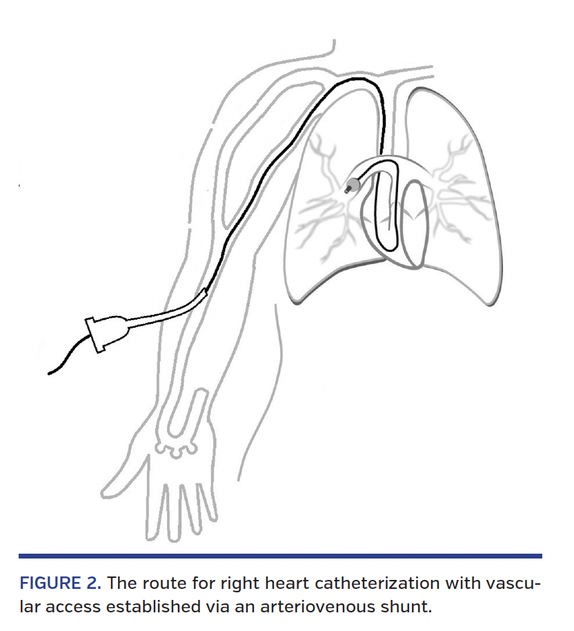 Right Heart Catheterization via Dialysis Arteriovenous Shunts in End